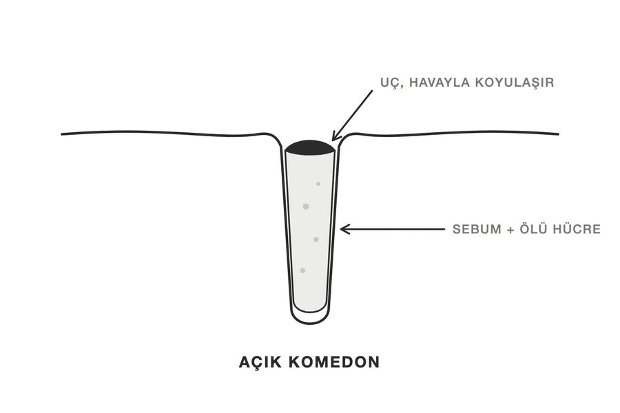 Açık komedonun kesit çizimi: gözenekte sebum ve ölü hücre tıkacı